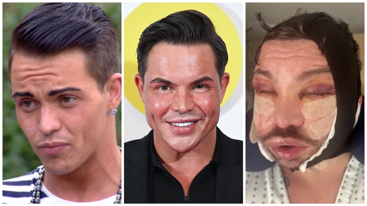 Bobby Norris reveals his new face after surgery and discusses future procedures, past filler use, and a life-changing health scare.